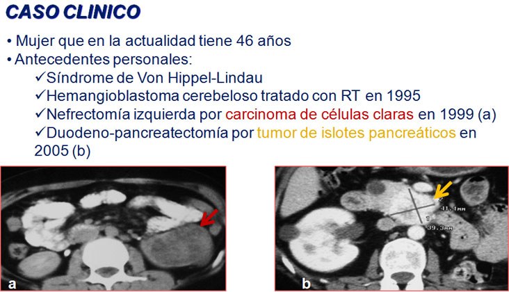Ablación por radiofrecuencia de varios tumores renales en paciente monorrena con enfermedad de von hippel-lindau — diapositiva 2