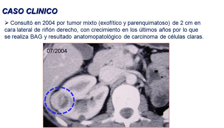 Ablación por radiofrecuencia de varios tumores renales en paciente monorrena con enfermedad de von hippel-lindau — diapositiva 3
