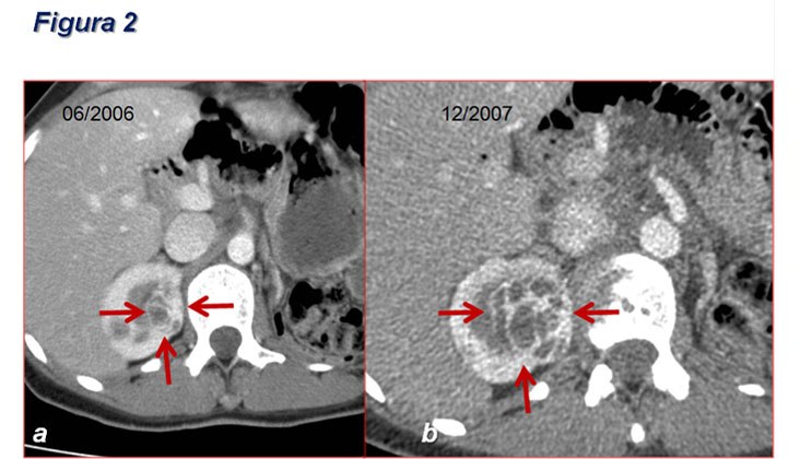 Ablación por radiofrecuencia de varios tumores renales en paciente monorrena con enfermedad de von hippel-lindau — diapositiva 5