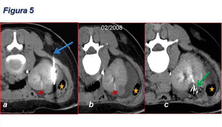 Ablación por radiofrecuencia de varios tumores renales en paciente monorrena con enfermedad de von hippel-lindau — diapositiva 8