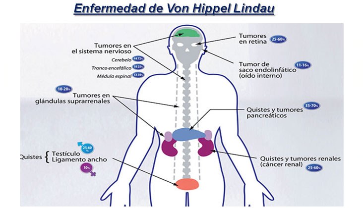 Ablación por radiofrecuencia de varios tumores renales en paciente monorrena con enfermedad de von hippel-lindau — diapositiva 11