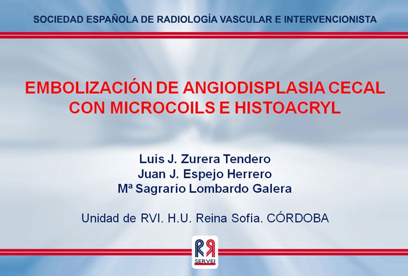 Embolización de angiodisplasia cecal con microcoils e histoacryl — diapositiva 1