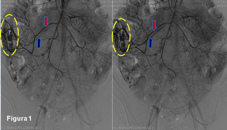 Embolización de angiodisplasia cecal con microcoils e histoacryl — diapositiva 2