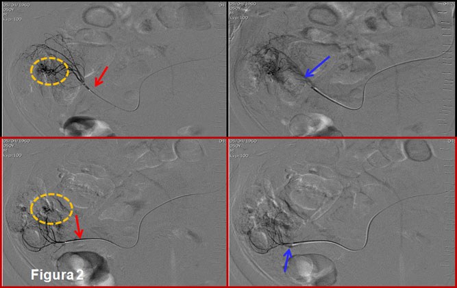Embolización de angiodisplasia cecal con microcoils e histoacryl — diapositiva 3
