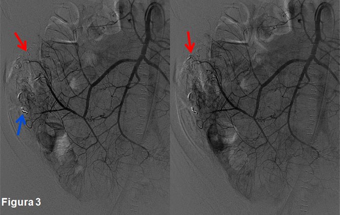 Embolización de angiodisplasia cecal con microcoils e histoacryl — diapositiva 4