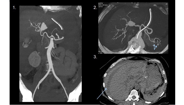 Hemoperitoneo Masivo por Rotura de Aneurisma Hepático en un caso de “Segmental Arterial Mediolysis” Embolización con Onyx — diapositiva 4