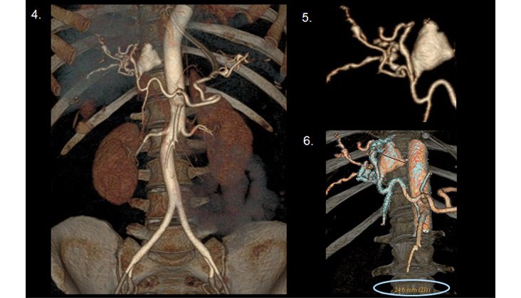 Hemoperitoneo Masivo por Rotura de Aneurisma Hepático en un caso de “Segmental Arterial Mediolysis” Embolización con Onyx — diapositiva 5