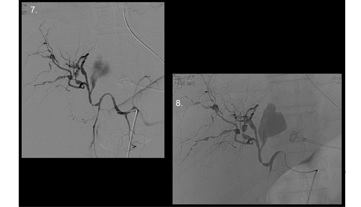 Hemoperitoneo Masivo por Rotura de Aneurisma Hepático en un caso de “Segmental Arterial Mediolysis” Embolización con Onyx — diapositiva 7