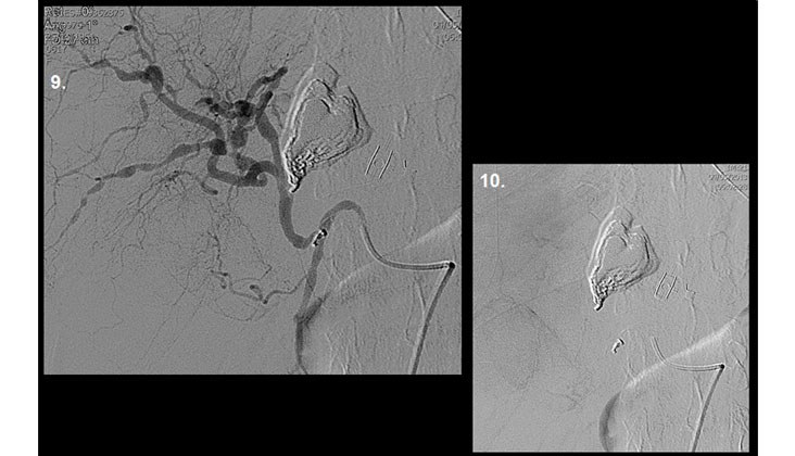 Hemoperitoneo Masivo por Rotura de Aneurisma Hepático en un caso de “Segmental Arterial Mediolysis” Embolización con Onyx — diapositiva 8