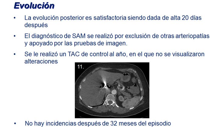Hemoperitoneo Masivo por Rotura de Aneurisma Hepático en un caso de “Segmental Arterial Mediolysis” Embolización con Onyx — diapositiva 9