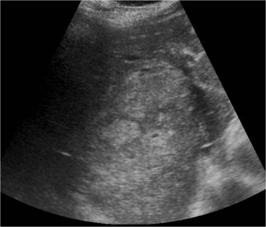 Hemorragia intrahepática — diapositiva 2