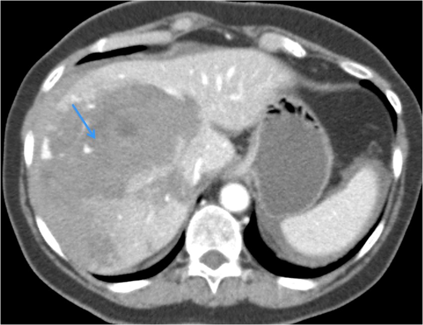 Hemorragia intrahepática — diapositiva 3
