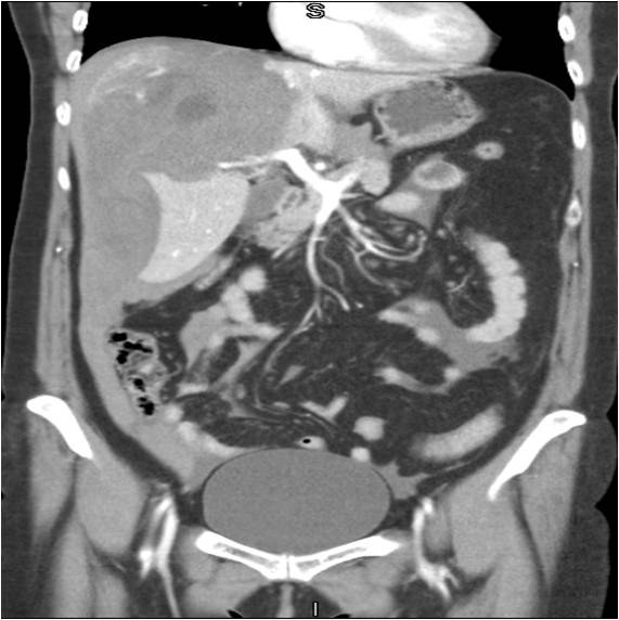 Hemorragia intrahepática — diapositiva 4