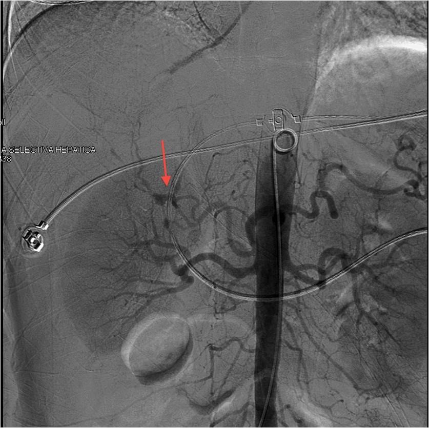 Hemorragia intrahepática — diapositiva 5