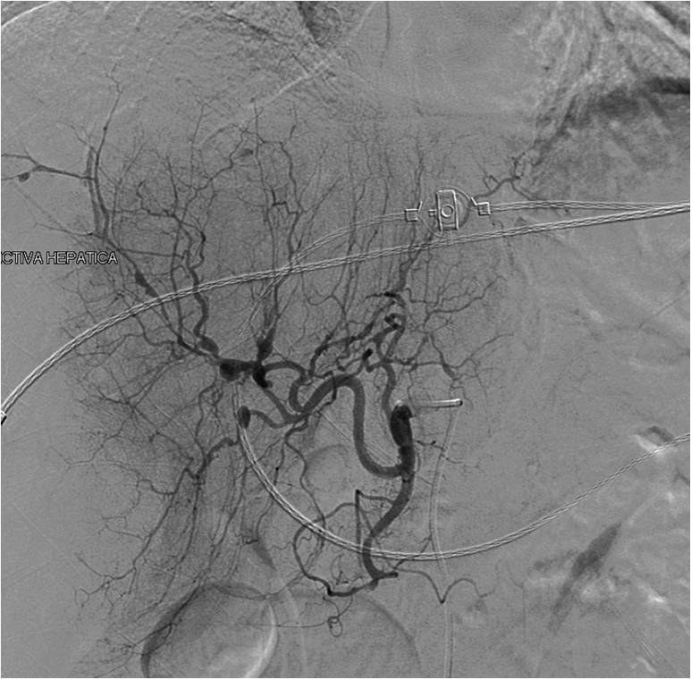 Hemorragia intrahepática — diapositiva 6