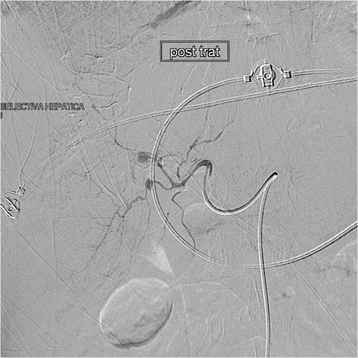 Hemorragia intrahepática — diapositiva 7