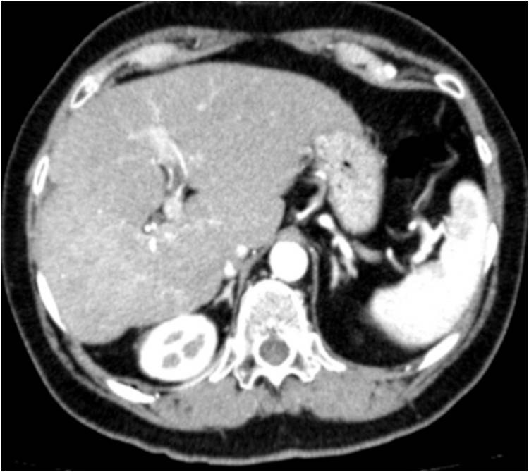 Hemorragia intrahepática — diapositiva 8