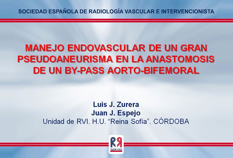 Manejo endovascular de un gran pseudoaneurisma en la anastomosis de un by-pass aorto-bifemoral — diapositiva 1