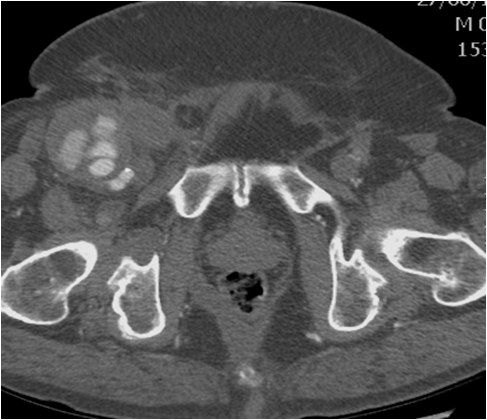 Manejo endovascular de un gran pseudoaneurisma en la anastomosis de un by-pass aorto-bifemoral — diapositiva 2