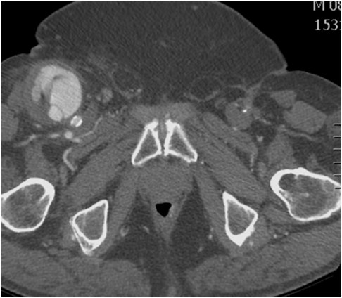 Manejo endovascular de un gran pseudoaneurisma en la anastomosis de un by-pass aorto-bifemoral — diapositiva 3