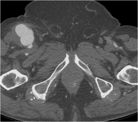Manejo endovascular de un gran pseudoaneurisma en la anastomosis de un by-pass aorto-bifemoral — diapositiva 4