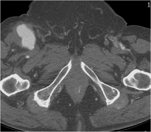 Manejo endovascular de un gran pseudoaneurisma en la anastomosis de un by-pass aorto-bifemoral — diapositiva 5