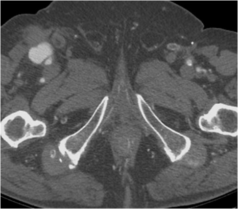 Manejo endovascular de un gran pseudoaneurisma en la anastomosis de un by-pass aorto-bifemoral — diapositiva 6