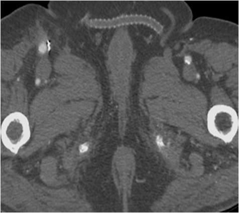 Manejo endovascular de un gran pseudoaneurisma en la anastomosis de un by-pass aorto-bifemoral — diapositiva 7