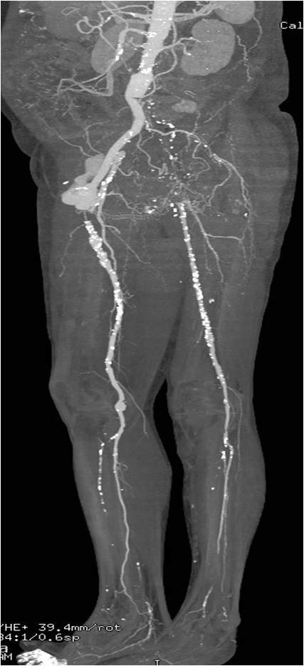 Manejo endovascular de un gran pseudoaneurisma en la anastomosis de un by-pass aorto-bifemoral — diapositiva 8