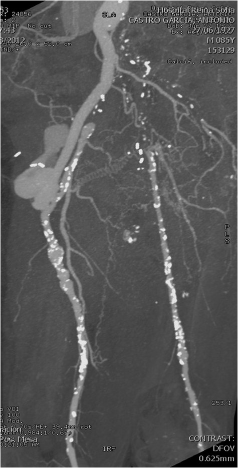Manejo endovascular de un gran pseudoaneurisma en la anastomosis de un by-pass aorto-bifemoral — diapositiva 9