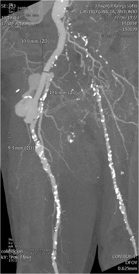 Manejo endovascular de un gran pseudoaneurisma en la anastomosis de un by-pass aorto-bifemoral — diapositiva 10