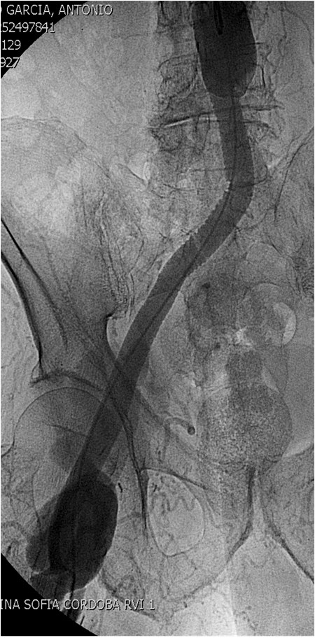 Manejo endovascular de un gran pseudoaneurisma en la anastomosis de un by-pass aorto-bifemoral — diapositiva 11