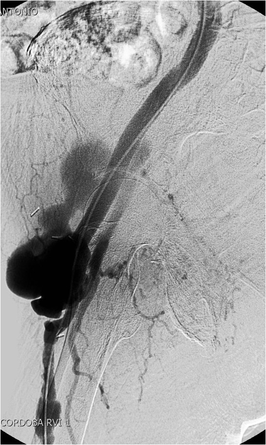 Manejo endovascular de un gran pseudoaneurisma en la anastomosis de un by-pass aorto-bifemoral — diapositiva 12