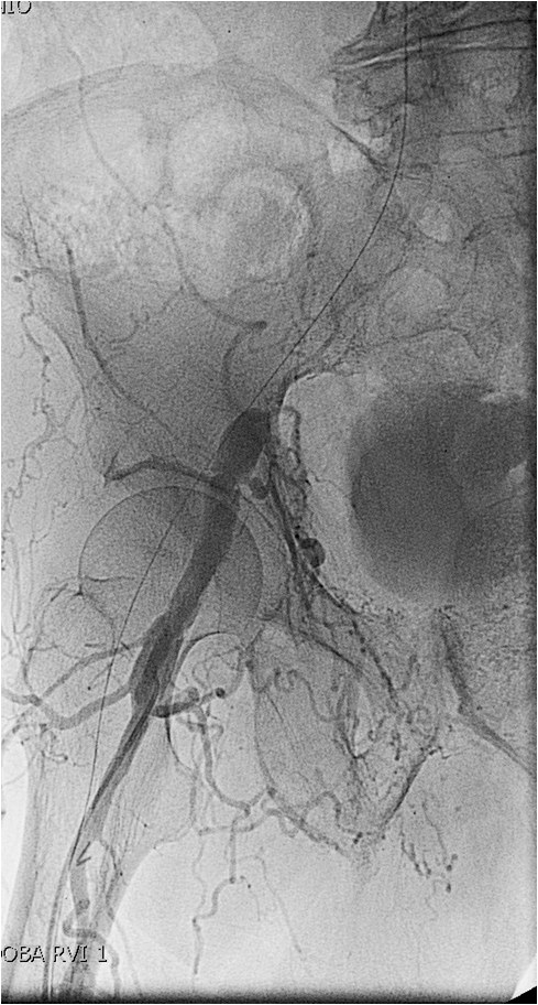 Manejo endovascular de un gran pseudoaneurisma en la anastomosis de un by-pass aorto-bifemoral — diapositiva 13