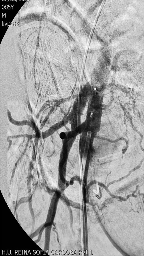 Manejo endovascular de un gran pseudoaneurisma en la anastomosis de un by-pass aorto-bifemoral — diapositiva 14