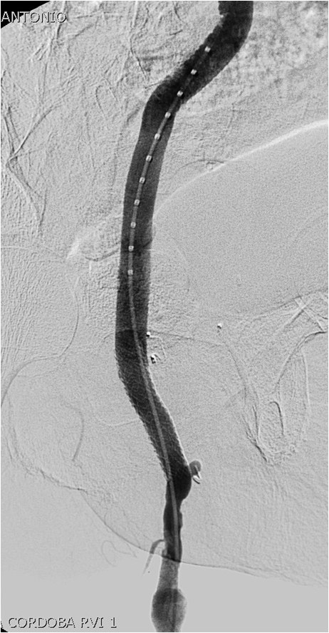 Manejo endovascular de un gran pseudoaneurisma en la anastomosis de un by-pass aorto-bifemoral — diapositiva 15