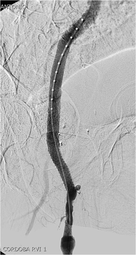 Manejo endovascular de un gran pseudoaneurisma en la anastomosis de un by-pass aorto-bifemoral — diapositiva 16