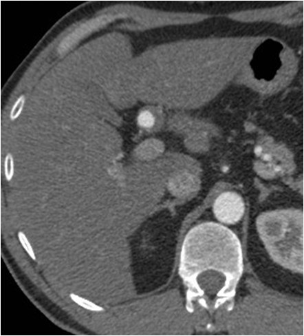 Rotura y posterior trombosis de “bypass” femoropoplíteo, con oclusión crónica de troncos distales: solución endovascular — diapositiva 3