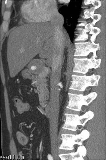 Rotura y posterior trombosis de “bypass” femoropoplíteo, con oclusión crónica de troncos distales: solución endovascular — diapositiva 6