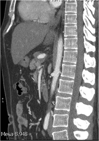 Rotura y posterior trombosis de “bypass” femoropoplíteo, con oclusión crónica de troncos distales: solución endovascular — diapositiva 8