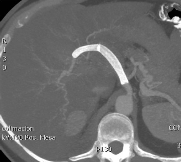 Rotura y posterior trombosis de “bypass” femoropoplíteo, con oclusión crónica de troncos distales: solución endovascular — diapositiva 18