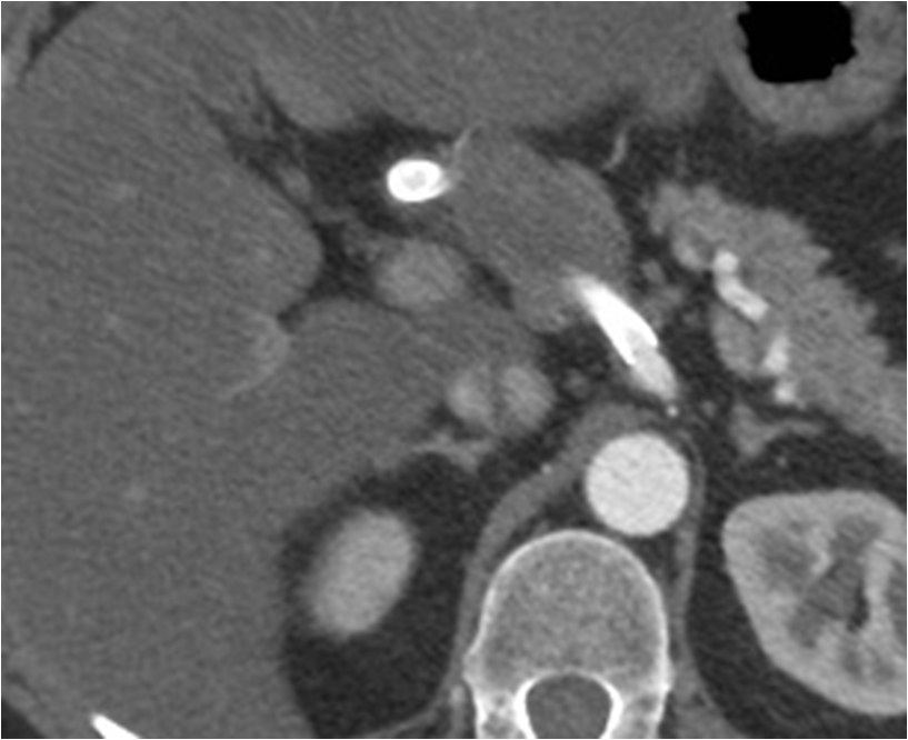 Rotura y posterior trombosis de “bypass” femoropoplíteo, con oclusión crónica de troncos distales: solución endovascular — diapositiva 23