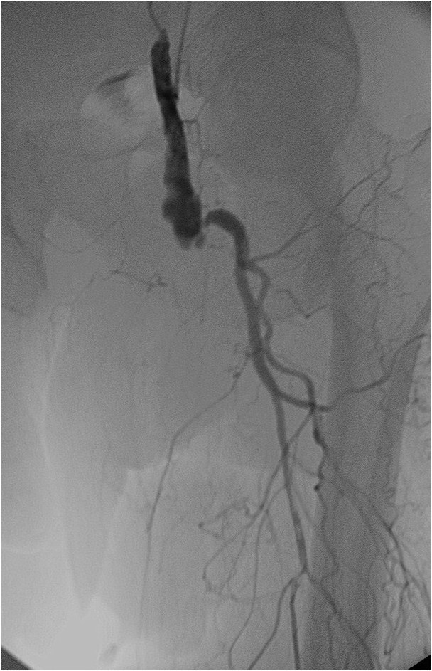 Rotura y posterior trombosis de “bypass” femoropoplíteo, con oclusión crónica de troncos distales: solución endovascular — diapositiva 25