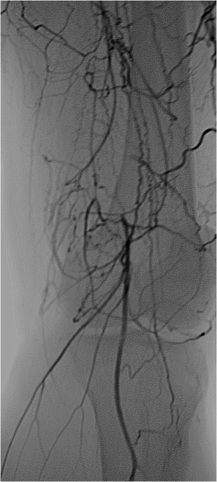 Rotura y posterior trombosis de “bypass” femoropoplíteo, con oclusión crónica de troncos distales: solución endovascular — diapositiva 26