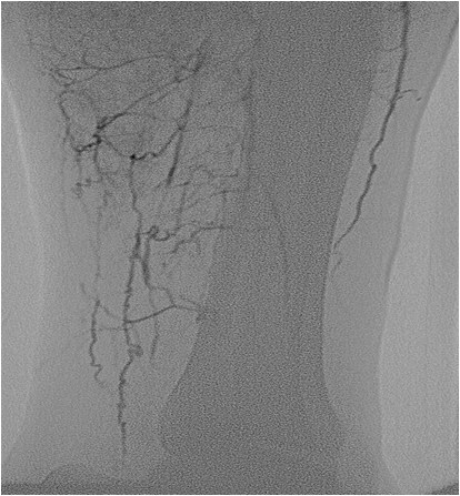 Rotura y posterior trombosis de “bypass” femoropoplíteo, con oclusión crónica de troncos distales: solución endovascular — diapositiva 27