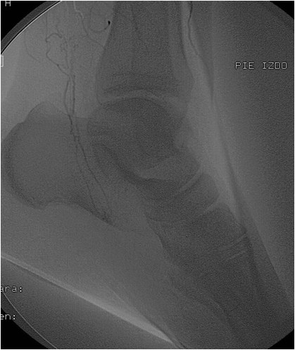 Rotura y posterior trombosis de “bypass” femoropoplíteo, con oclusión crónica de troncos distales: solución endovascular — diapositiva 28
