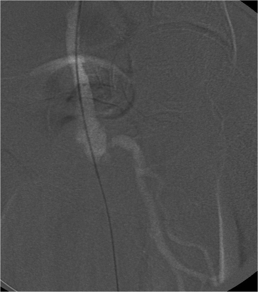 Rotura y posterior trombosis de “bypass” femoropoplíteo, con oclusión crónica de troncos distales: solución endovascular — diapositiva 29