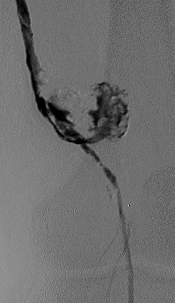Rotura y posterior trombosis de “bypass” femoropoplíteo, con oclusión crónica de troncos distales: solución endovascular — diapositiva 30