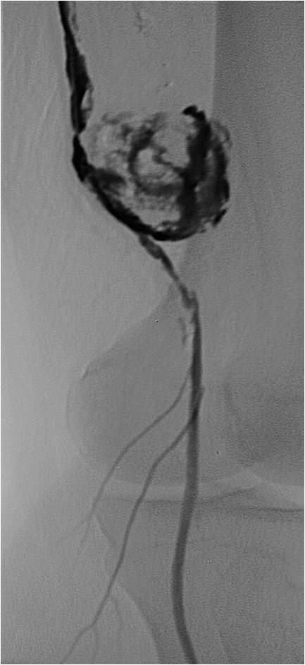 Rotura y posterior trombosis de “bypass” femoropoplíteo, con oclusión crónica de troncos distales: solución endovascular — diapositiva 31