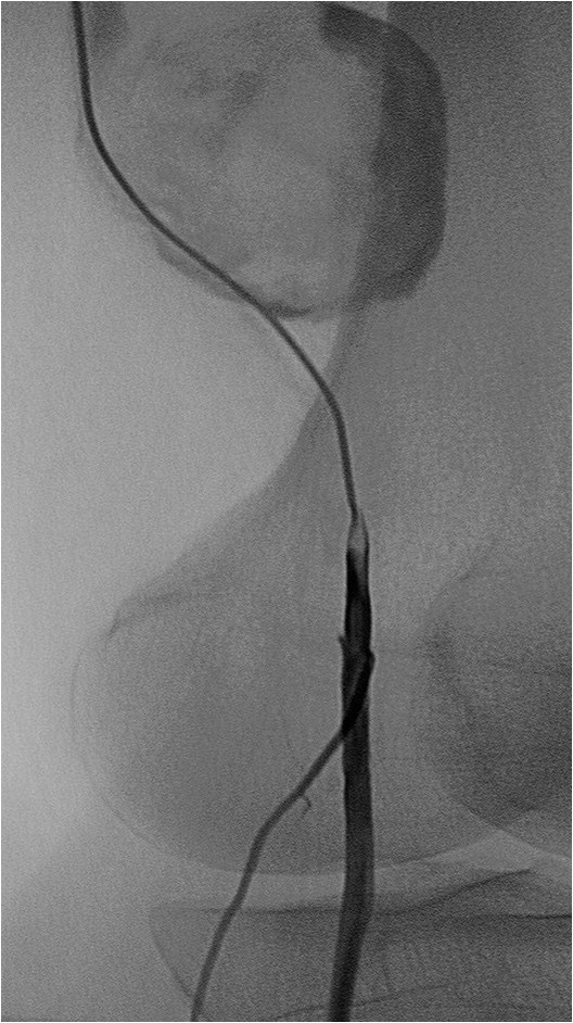 Rotura y posterior trombosis de “bypass” femoropoplíteo, con oclusión crónica de troncos distales: solución endovascular — diapositiva 32